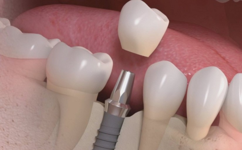 Lucruri neadevarate spuse despre implantul dentar