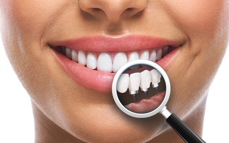 implant-dentar-bacau-805x503